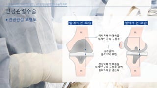 [삼성서울병원] 퇴행성 관절염 6편