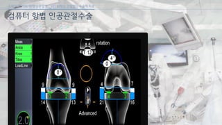 [삼성서울병원] 퇴행성 관절염 6편