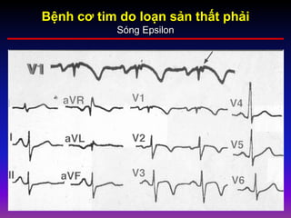 Bệnh cơ tim do loạn sản thất phải
Sóng Epsilon
 