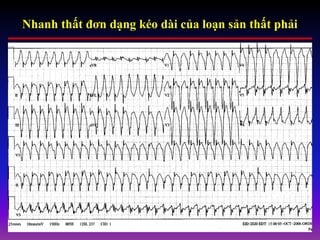 Nhanh thất đơn dạng kéo dài của loạn sản thất phải
 