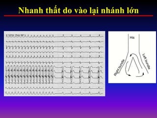 Nhanh thất do vào lại nhánh lớn
 