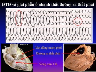 ĐTĐ và giải phẫu ổ nhanh thất đường ra thất phải
Van động mạch phổi
Đường ra thất phải
Vòng van 3 lá
 