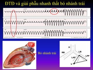 ĐTĐ và giải phẫu nhanh thất bó nhánh trái
Bó nhánh trái
 