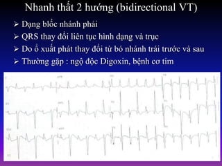 Nhanh thất 2 hướng (bidirectional VT)
 Dạng blốc nhánh phải
 QRS thay đổi liên tục hình dạng và trục
 Do ổ xuất phát thay đổi từ bó nhánh trái trước và sau
 Thường gặp : ngộ độc Digoxin, bệnh cơ tim
 