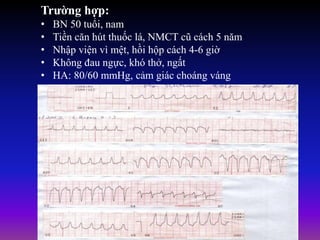 Trường hợp:
• BN 50 tuổi, nam
• Tiền căn hút thuốc lá, NMCT cũ cách 5 năm
• Nhập viện vì mệt, hồi hộp cách 4-6 giờ
• Không đau ngực, khó thở, ngất
• HA: 80/60 mmHg, cảm giác choáng váng
 