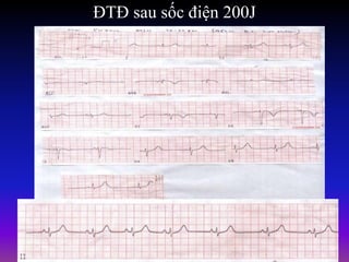 ĐTĐ sau sốc điện 200J
 