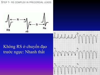Không RS ở chuyển đạo
trước ngực: Nhanh thất
 