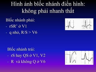 Hình ảnh blốc nhánh điển hình:
không phải nhanh thất
Blốc nhánh phải:
- rSR’ ở V1
- q nhỏ, R/S > V6
Blốc nhánh trái:
- rS hay QS ở V1, V2
- R và không Q ở V6
 