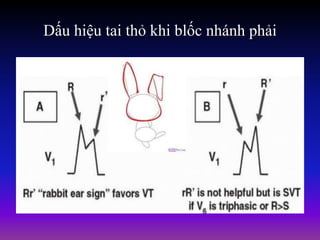 Dấu hiệu tai thỏ khi blốc nhánh phải
 