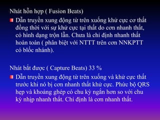 Nhát hỗn hợp ( Fusion Beats)
Dẫn truyền xung động từ trên xuống khử cực cơ thất
đồng thời với sự khử cực tại thất do cơn nhanh thất,
có hình dạng trộn lẫn. Chưa là chỉ định nhanh thất
hoàn toàn ( phân biệt với NTTT trên cơn NNKPTT
có blốc nhánh).
Nhát bắt được ( Capture Beats) 33 %
Dẫn truyền xung động từ trên xuống và khử cực thất
trước khi nó bị cơn nhanh thất khử cực. Phức bộ QRS
hẹp và khoảng ghép có chu kỳ ngắn hơn so với chu
kỳ nhịp nhanh thất. Chỉ định là cơn nhanh thất.
 