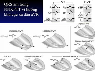 QRS âm trong
NNKPTT vì hướng
khử cực xa dần aVR
 