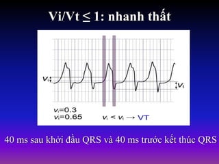 Vi/Vt ≤ 1: nhanh thất
40 ms sau khởi đầu QRS và 40 ms trước kết thúc QRS
 