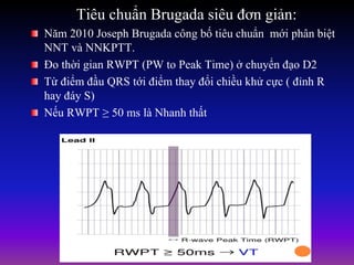 Tiêu chuẩn Brugada siêu đơn giản:
Năm 2010 Joseph Brugada công bố tiêu chuẩn mới phân biệt
NNT và NNKPTT.
Đo thời gian RWPT (PW to Peak Time) ở chuyển đạo D2
Từ điểm đầu QRS tới điểm thay đổi chiều khử cực ( đỉnh R
hay đáy S)
Nếu RWPT ≥ 50 ms là Nhanh thất
 