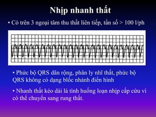Nhịp nhanh thất
• Có trên 3 ngoại tâm thu thất liên tiếp, tần số > 100 l/ph
• Phức bộ QRS dãn rộng, phân ly nhĩ thất, phức bộ
QRS không có dạng blốc nhánh điển hình
• Nhanh thất kéo dài là tình huống loạn nhịp cấp cứu vì
có thể chuyển sang rung thất.
 