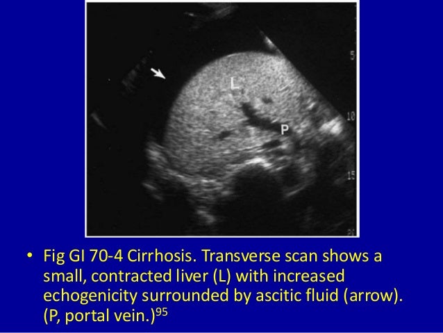 70 generalized increased echogenicity of the liver 70 generalized increased echogenicity of the liver