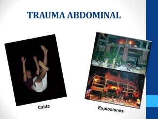 TRAUMA ABDOMINAL
 