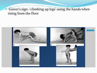  Gower's sign -'climbing up legs' using the hands when
rising from the floor
 