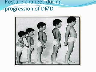 Posture changes during
progression of DMD
 