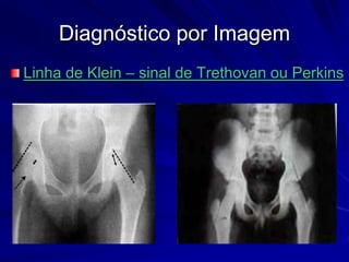 Diagnóstico por Imagem
Linha de Klein – sinal de Trethovan ou Perkins
 