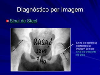 Diagnóstico por Imagem
Sinal de Steel
Linha de esclerose
sobreposta á
imagem do colo –
sinal do crescente
de Steel
 