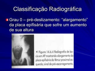 Classificação Radiográfica
Grau 0 – pré-deslizamento: “alargamento”
da placa epifisária que sofre um aumento
de sua altura
 