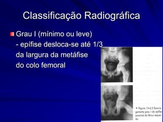Classificação Radiográfica
Grau I (mínimo ou leve)
- epífise desloca-se até 1/3
da largura da metáfise
do colo femoral
 