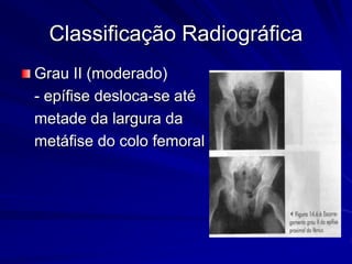 Classificação Radiográfica
Grau II (moderado)
- epífise desloca-se até
metade da largura da
metáfise do colo femoral
 