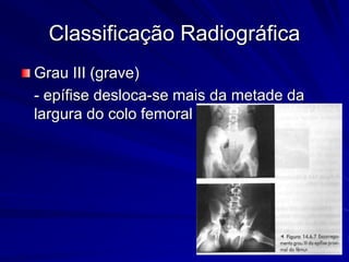 Classificação Radiográfica
Grau III (grave)
- epífise desloca-se mais da metade da
largura do colo femoral
 