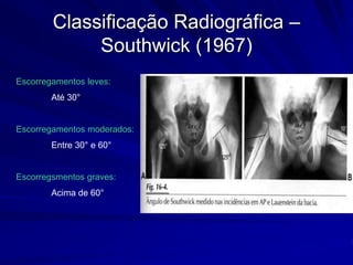 Classificação Radiográfica –
Southwick (1967)
Escorregamentos leves:
Até 30°
Escorregamentos moderados:
Entre 30° e 60°
Escorregsmentos graves:
Acima de 60°
 