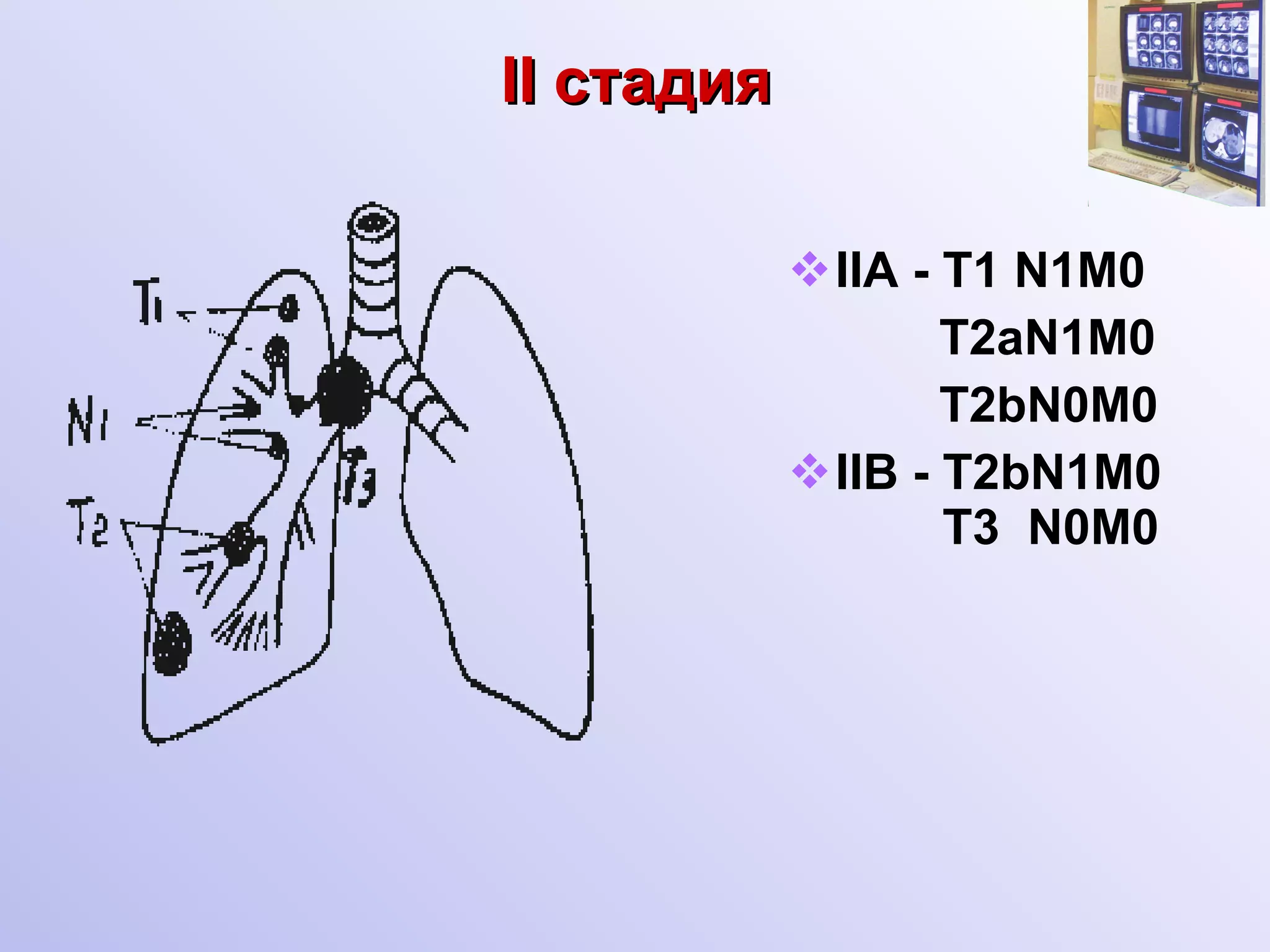 II c тадия   IIA - T1 N1M0 T2aN1M0 T2bN0M0  IIB - T2bN1M0   T3  N0M0 