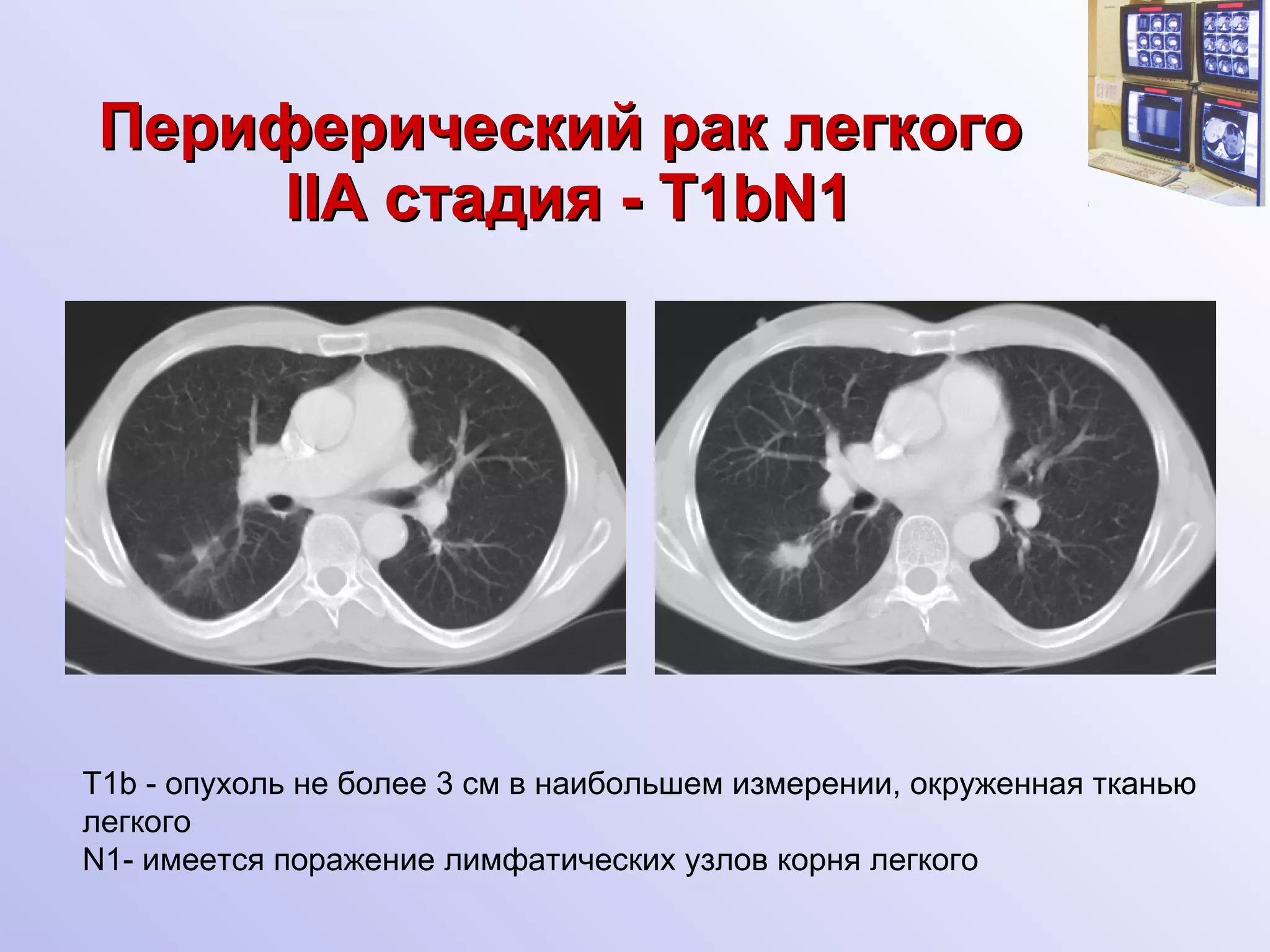 Периферический рак легкого   IIA  стадия  -  Т1 bN1 Т1 b  - опухоль не более 3 см в наибольшем измерении, окруженная тканью легкого N1- имеется поражение лимфатических узлов корня легкого  