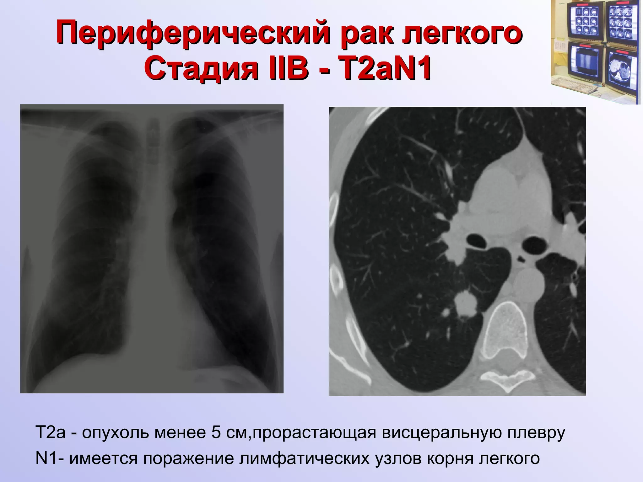Периферический рак легкого Стадия  II В -  Т 2aN1 Т2 a  - опухоль менее 5 см,прорастающая висцеральную плевру N1- имеется поражение лимфатических узлов корня легкого 