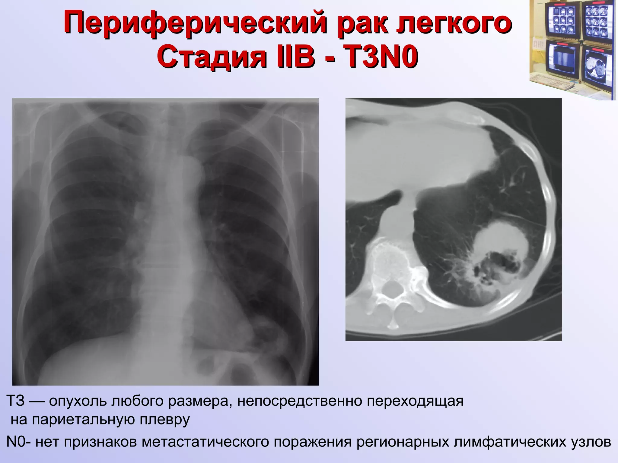 Периферический рак легкого Стадия  II В -  Т3 N0 ТЗ — опухоль любого размера, непосредственно переходящая на париетальную плевру N0- нет признаков метастатического поражения регионарных лимфатических узлов 
