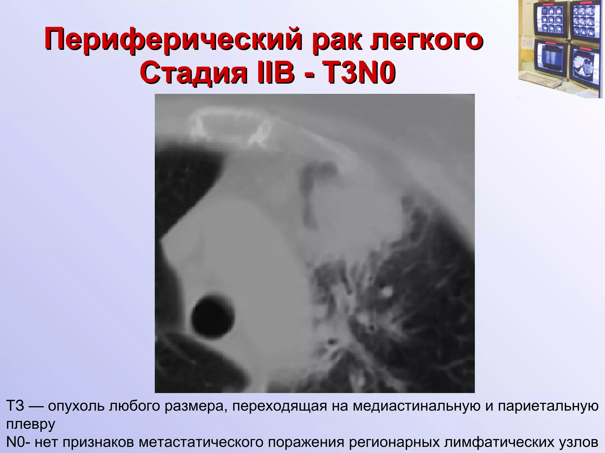 Периферический рак легкого   Стадия  II В -  Т3 N0 ТЗ — опухоль любого размера, переходящая на медиастинальную и париетальную плевру N0- нет признаков метастатического поражения регионарных лимфатических узлов 