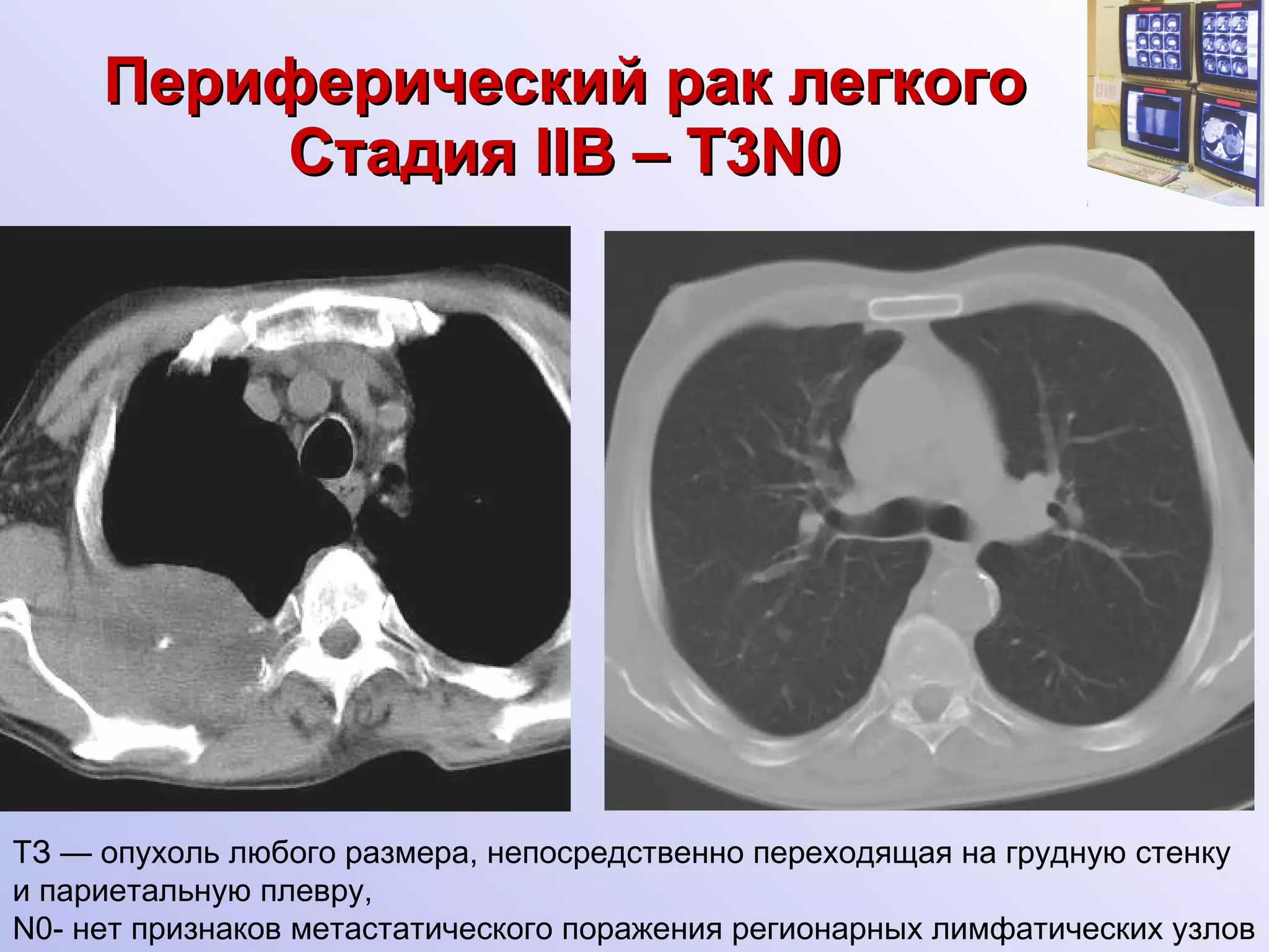 Периферический рак легкого Стадия  II В –  Т3 N0 ТЗ — опухоль любого размера, непосредственно переходящая на грудную стенку и париетальную плевру, N0- нет признаков метастатического поражения регионарных лимфатических узлов 
