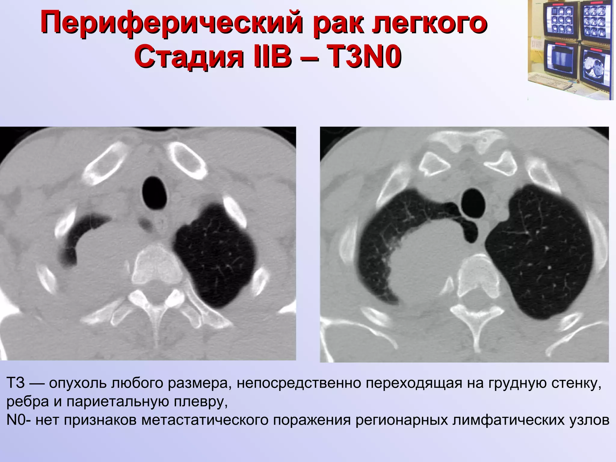 Периферический рак легкого   Стадия  II В –  Т3 N0 ТЗ — опухоль любого размера, непосредственно переходящая на грудную стенку, ребра и париетальную плевру, N0- нет признаков метастатического поражения регионарных лимфатических узлов 