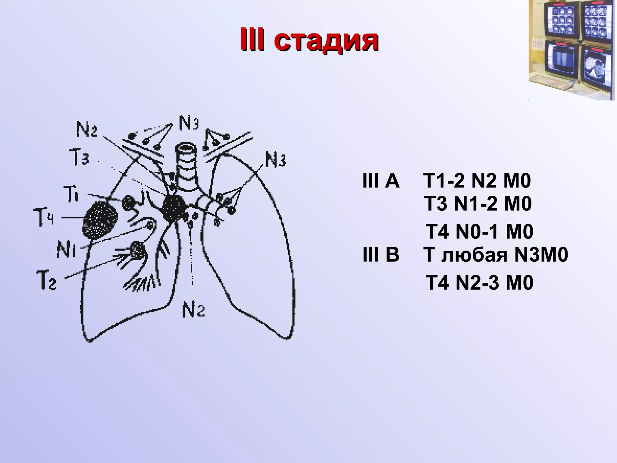 III c тадия   III A  T1-2   N2   M0    T 3   N1-2   M0 T4 N0-1 M0 III B  T  любая N3M0  T4   N 2-3  M0  