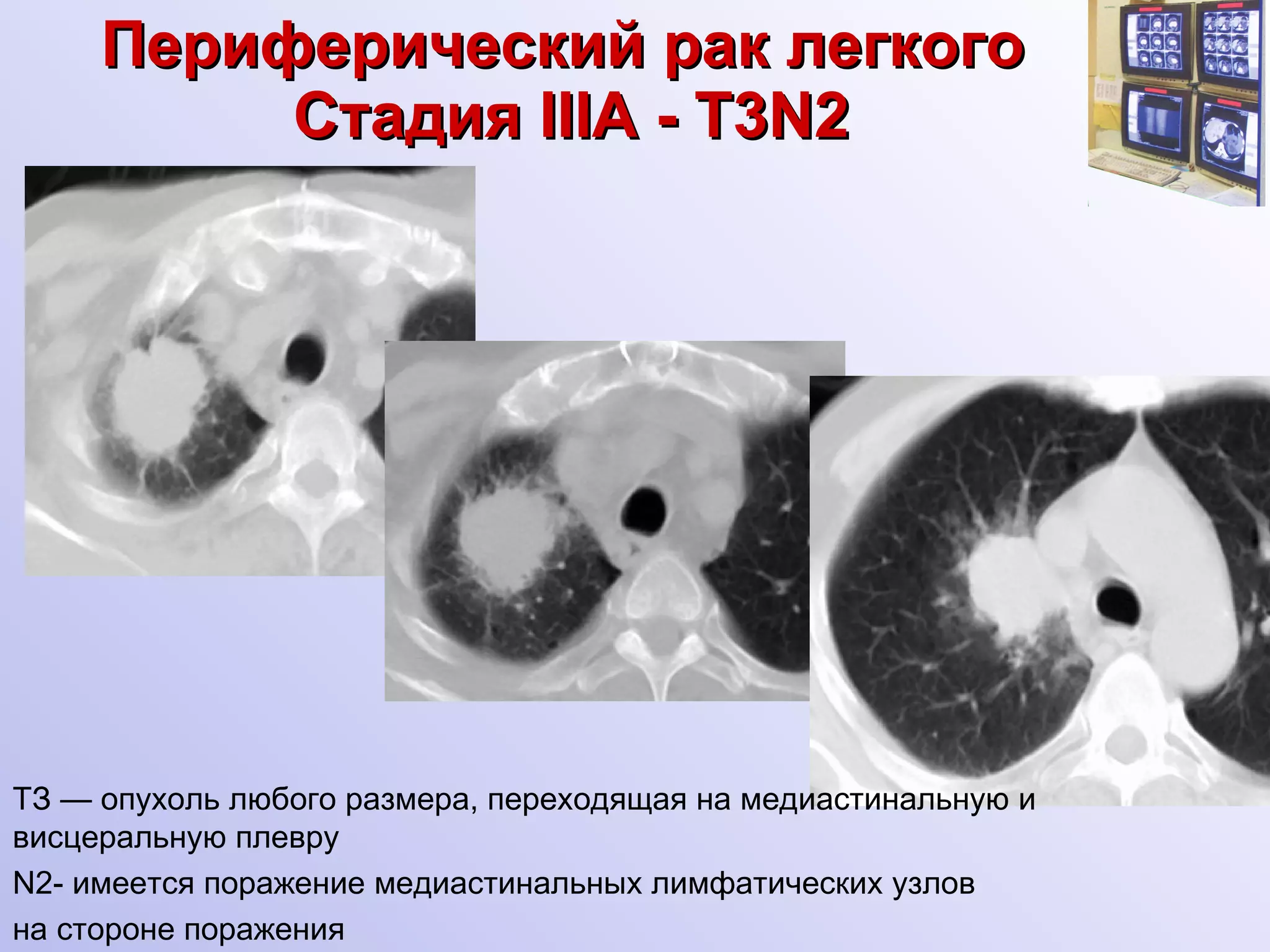Периферический рак легкого   Стадия  III А  - Т 3N 2 ТЗ — опухоль любого размера, переходящая на медиастинальную и  висцеральную плевру N2- имеется поражение медиастинальных лимфатических узлов  на стороне поражения 