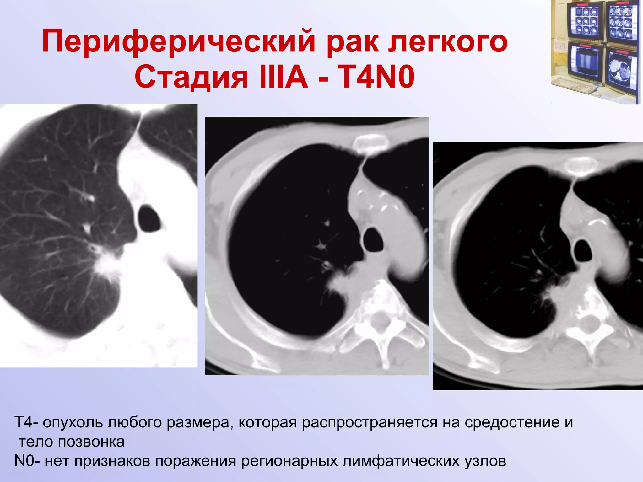 Периферический рак легкого Стадия  III А -  Т 4N0 Т4- опухоль любого размера, которая распространяется на средостение и  тело позвонка N0- нет признаков поражения регионарных лимфатических узлов 