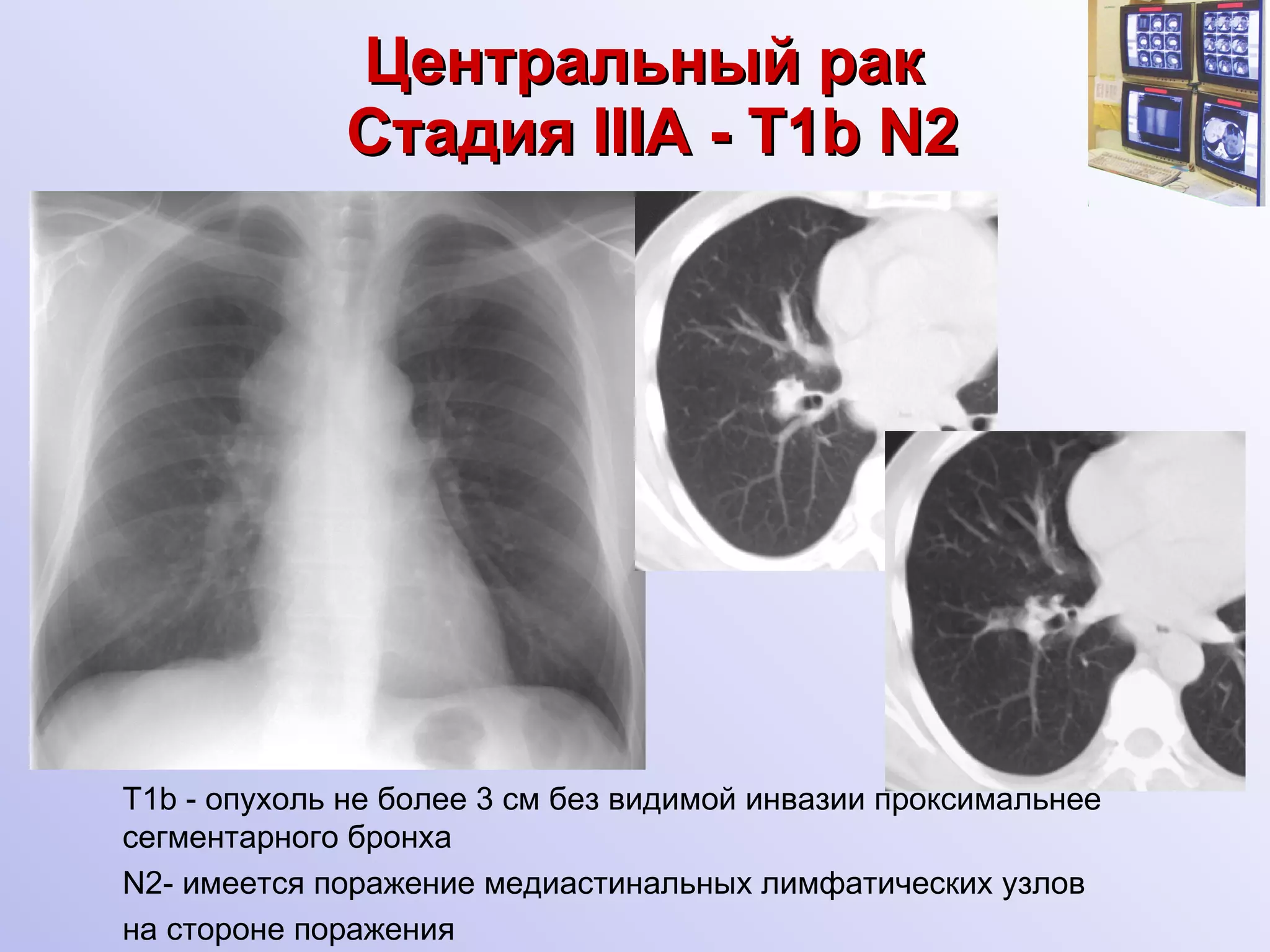 Центральный рак   Стадия  III А -  T1b N2 Т1 b  - опухоль не более 3 см без видимой инвазии проксимальнее сегментарного бронха N2- имеется поражение медиастинальных лимфатических узлов  на стороне поражения 