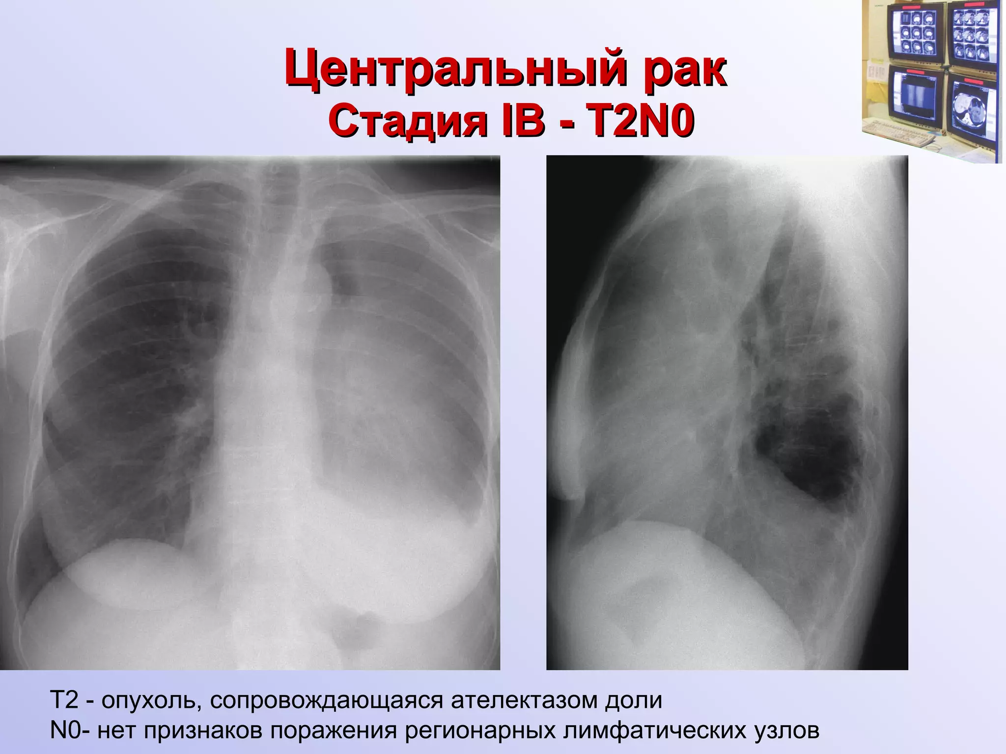 Центральный рак   Стадия  I В - T2N0 Т2 - опухоль, сопровождающаяся ателектазом доли N0- нет признаков поражения регионарных лимфатических узлов 