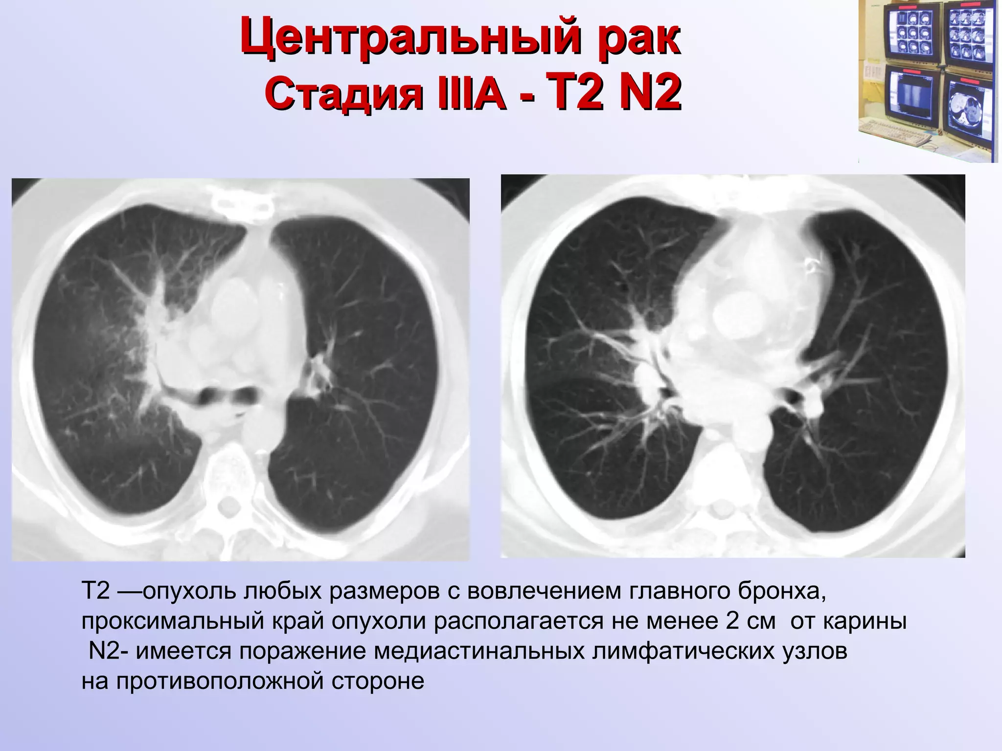 Центральный рак     Стадия  III А -  T2 N2 Т2 —опухоль любых размеров с вовлечением главного бронха,  проксимальный край опухоли располагается не менее 2 см  от карины N 2- имеется поражение медиастинальных лимфатических узлов  на противоположной стороне 