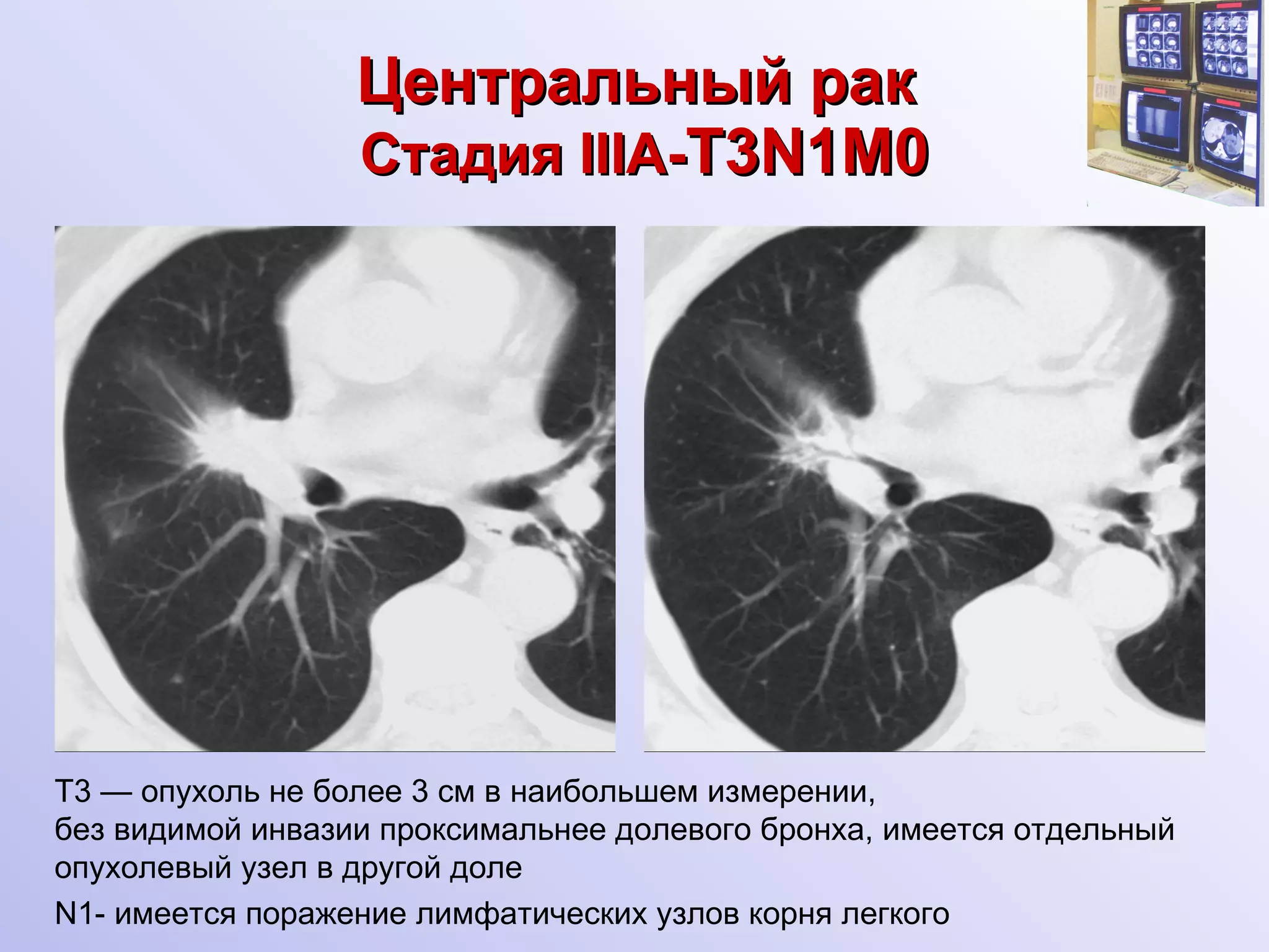 Центральный рак   Стадия  IIIA - T 3 N1M 0 Т3 — опухоль не более 3 см в наибольшем измерении,  без видимой инвазии проксимальнее долевого бронха, имеется отдельный опухолевый узел в другой доле N1- имеется поражение лимфатических узлов корня легкого  