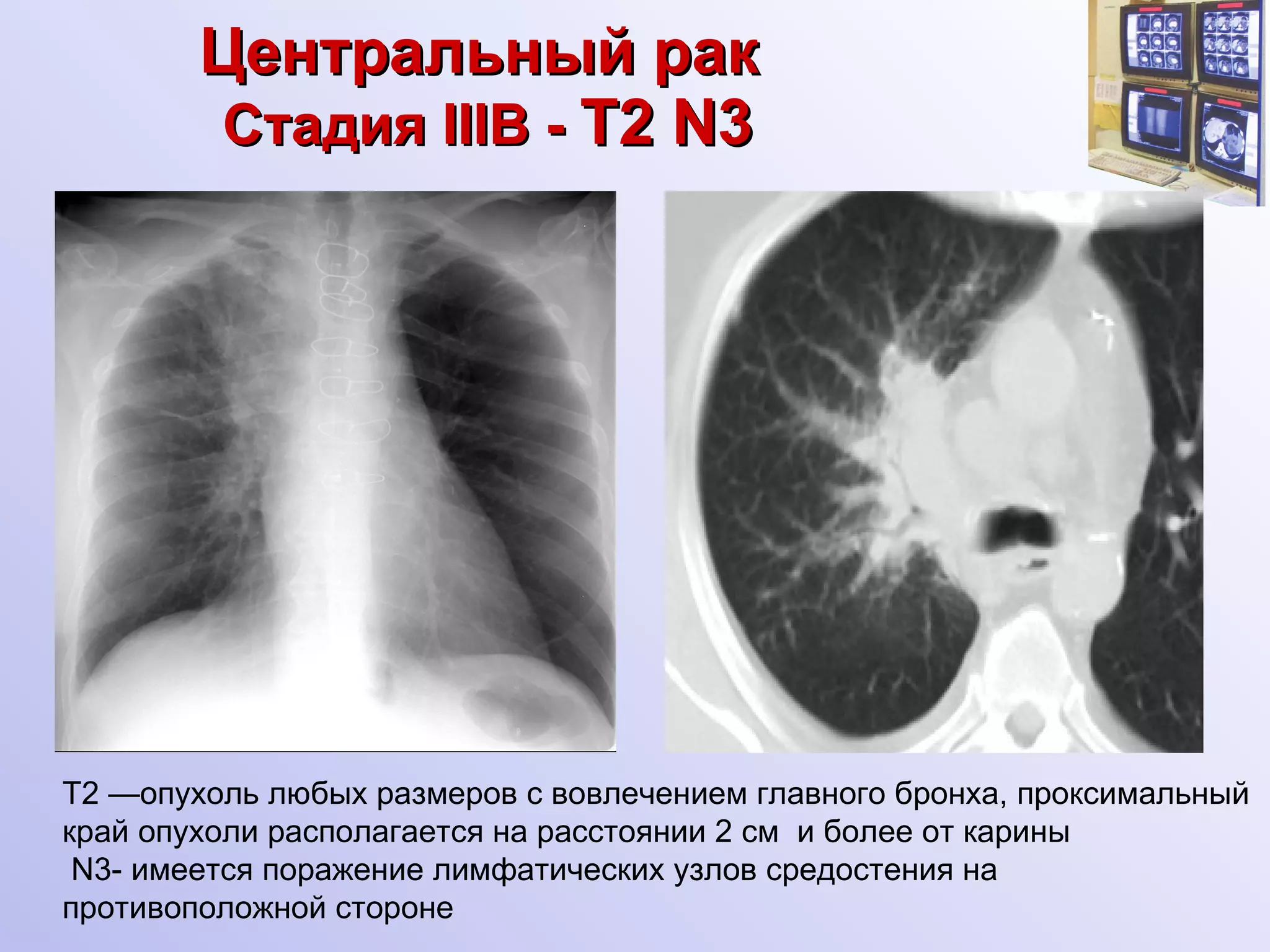 Центральный рак   Стадия  III В -  T2 N 3 Т2 —опухоль любых размеров с вовлечением главного бронха, проксимальный край опухоли располагается на расстоянии 2 см  и более от карины N 3- имеется поражение лимфатических узлов средостения на противоположной стороне 