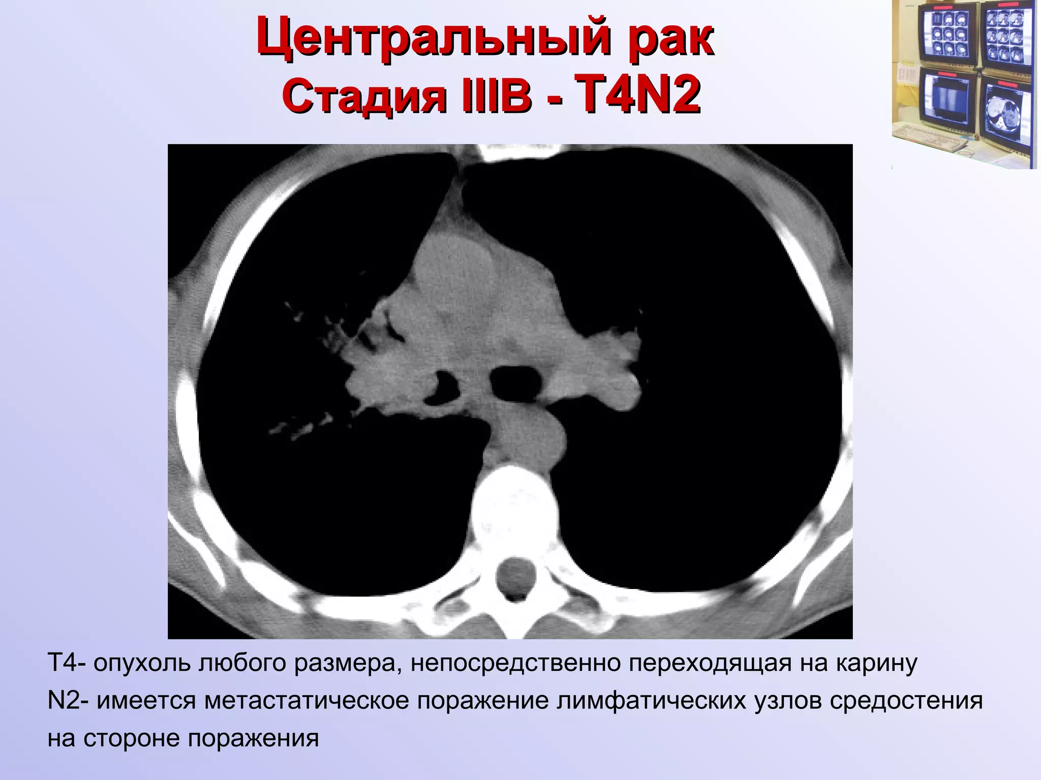 Центральный рак   Стадия  III В -  T 4 N2 Т4- опухоль любого размера, непосредственно переходящая на карину N2- имеется метастатическое поражение лимфатических узлов средостения  на стороне поражения 