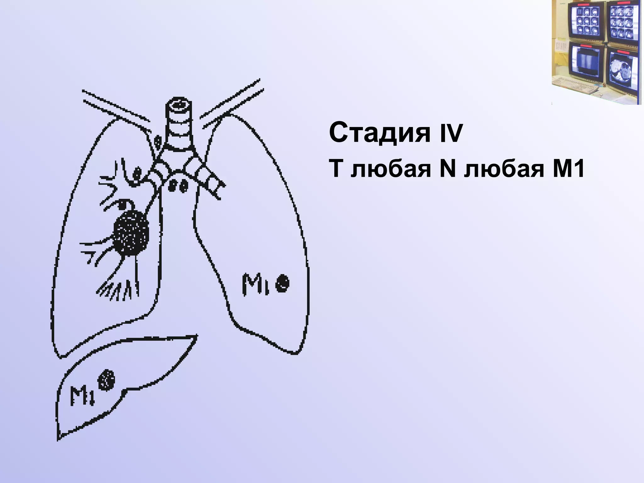 Стадия   I V T любая   N любая M1  