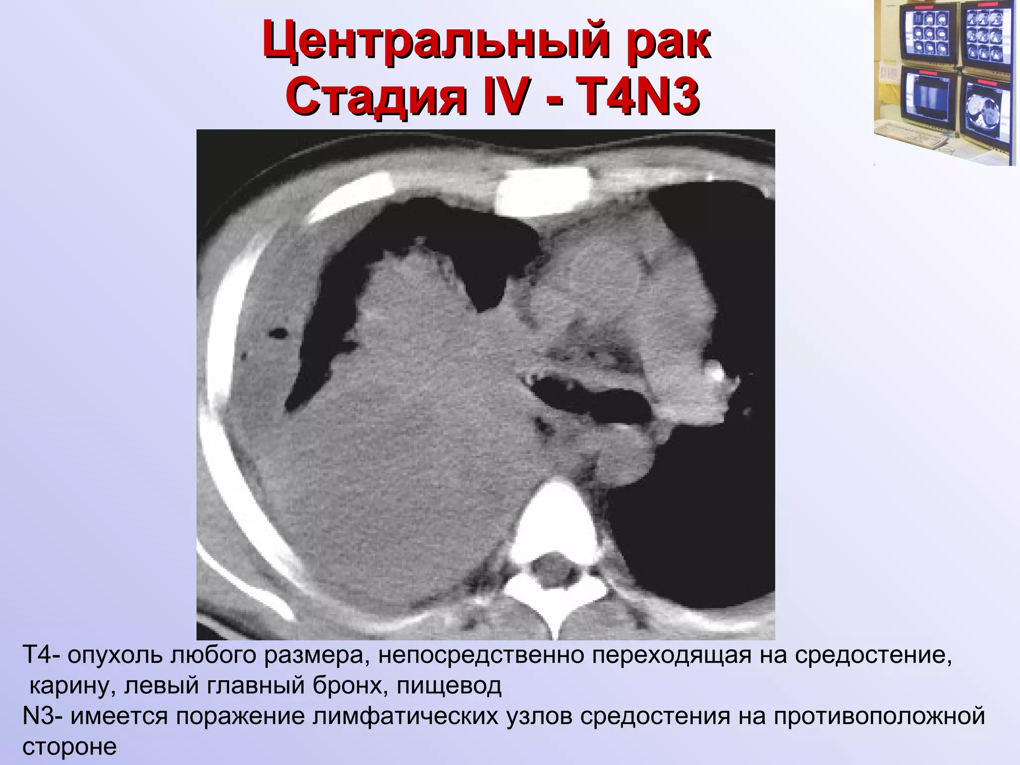 Центральный рак   Стадия   I V -  T4N 3 Т4- опухоль любого размера, непосредственно переходящая на средостение, карину, левый главный бронх, пищевод N 3- имеется поражение лимфатических узлов средостения на противоположной стороне 