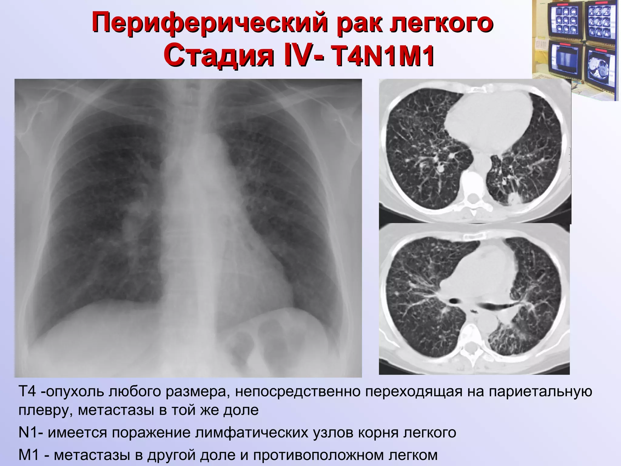 Периферический рак легкого    Стадия  I V-   Т4 N1 М1 Т4  - опухоль любого размера, непосредственно переходящая на париетальную плевру, метастазы в той же доле N1- имеется поражение лимфатических узлов корня легкого  М1 - метастазы в другой доле и противоположном легком 