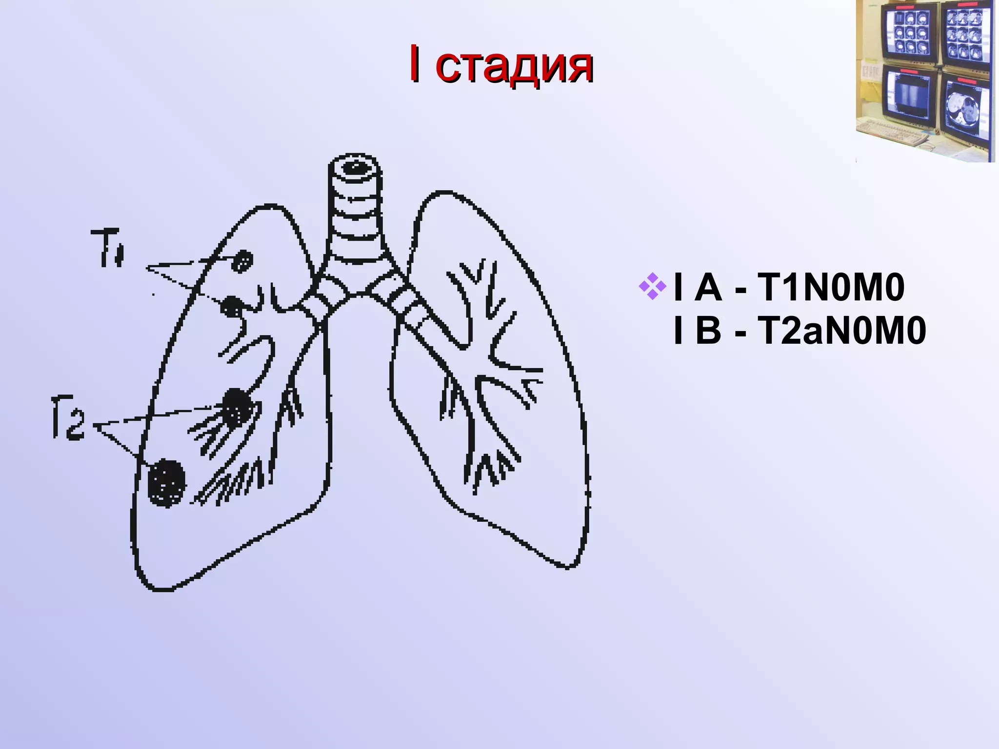 I c тадия   I A - T1N0M0 I   B - T2aN0M0   