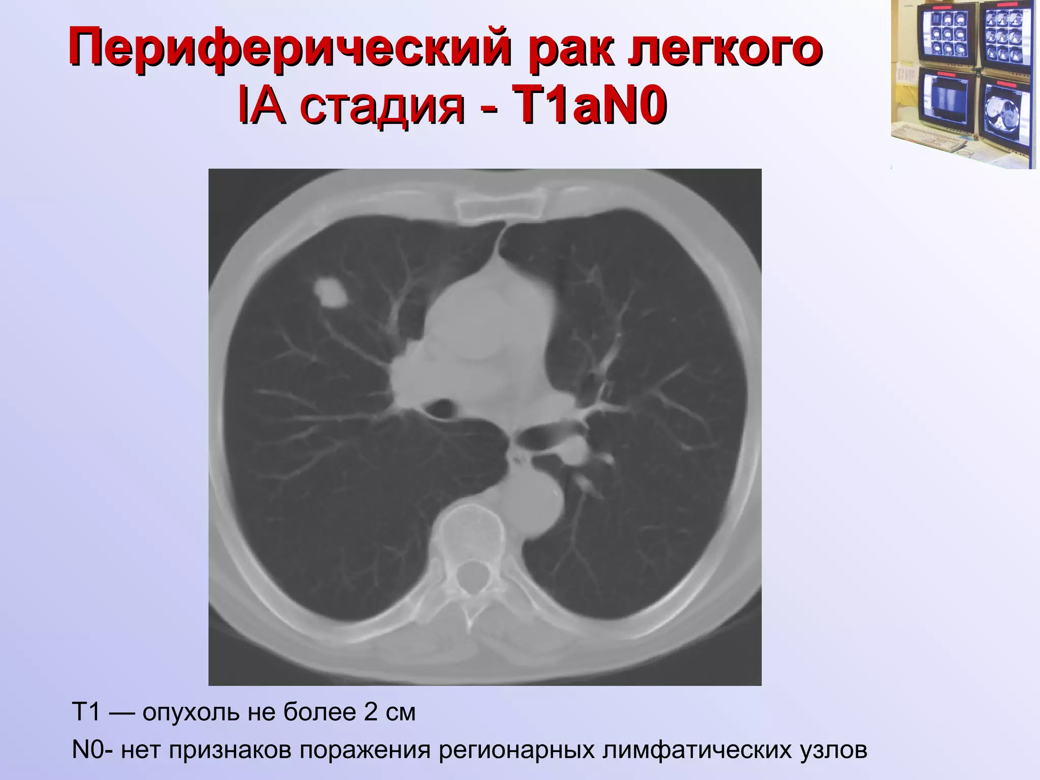 Периферический рак легкого   I А  c тадия  -  Т1 aN0 А Т1 — опухоль не более  2  см N0- нет признаков поражения регионарных лимфатических узлов 